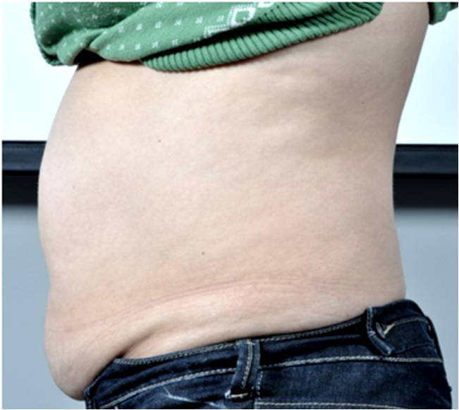 Body Contouring Treatment - Stomach Before Treatment . Sharplight