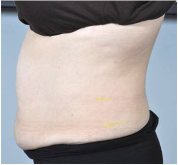 Body Contouring Treatment - Stomach After 11 Treatments . Sharplightech