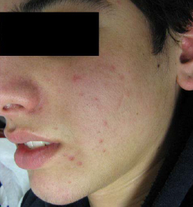 Acne Treatment - Skin Type 4 Before . Sharplight