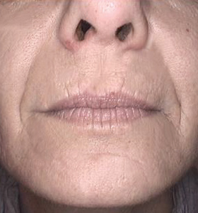 Skin Rejuvenation Treatment - Lower Face After 4 Treatments . Sharplight