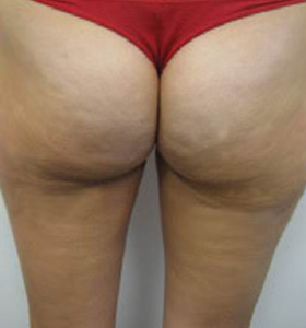 Body Contouring Treatment- Buttocks and thighs After 8 Treatments . Sharplight