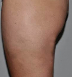 Body Contouring Treatment- Thigh After 8 Treatments. Sharplight