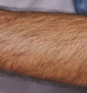 Hair Removal Treatment- Arm Before - Sharplight