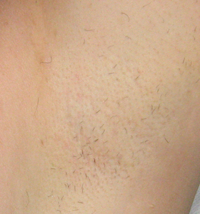 Hair Removal Treatment - Armpits After 2 Treatment - Sharplight