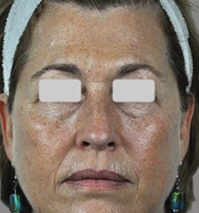 Skin Rejuvenation Treatment - Full Face Before . Sharplight