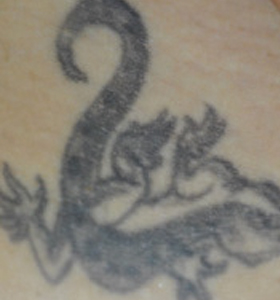 Tattoo Removal Treatment-lizard Before Treatment . Sharplight