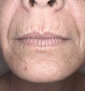 Skin Rejuvenation Treatment - Lower Face - Before Treatment . Sharplight