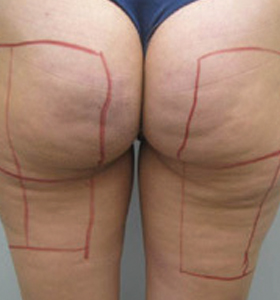 Body Contouring Treatment - Back Thigh And Buttocks Before . Sharplight