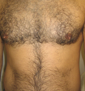 Hair Removal Treatment - A Man's Chest. Before Treatment - Sharplight