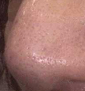 Skin Rejuvenation Treatment Male Nose After 3 Monthly . Sharplight