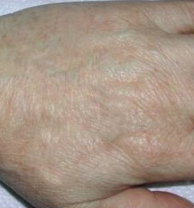 Pigmented Lesions Treatment - Hands After 2 Treatment . Sharplight