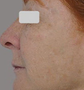 Skin Rejuvenation Treatment For Middle Aged Woman After Treatment . Sharplight
