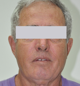 Skin Rejuvenation Treatment -Men- After . Sharplight