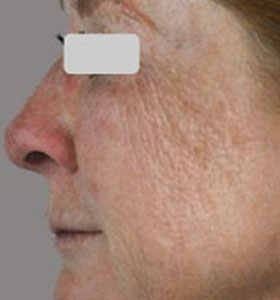 Skin Rejuvenation Treatment For Middle Aged Woman Before Treatment . Sharplight