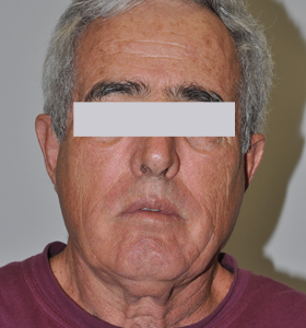 Vascular Lesions Treatment For Middle Aged Man- Before Treatments . Sharplightech