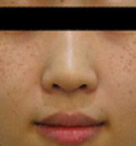 Pigmented Lesions Treatment - Young Girl - sun pigmented Before . Sharplight