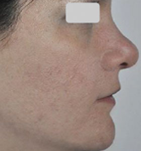 Acne Treatment For Teen Age Girl - After 12 Treatments . Sharplight