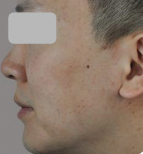 Acne Type 2 After 4 Treatments . Sharplight