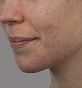 Acne Treatment For Young Women Before Treatment . Sharplight