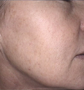 Skin Rejuvenation Cheek After 2 Treatments . Sharplight