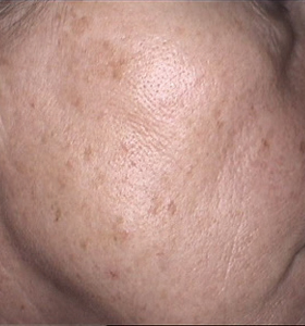 Skin Rejuvenation Cheek Before Treatment . Sharplight