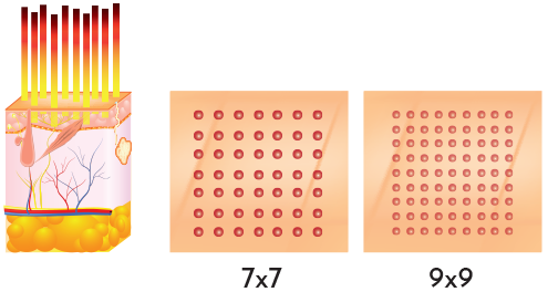 A demonstration of how Er: YAG 2940 Fractional Laser works . SharpLight