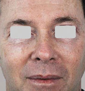 Skin Rejuvenation Treatment For Man Before Treatment . Sharplight