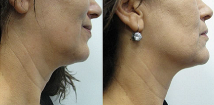 IR Hand piece for Face and Body Skin Tightening: a Hot Topic Utilizing Deep Dermal Heating