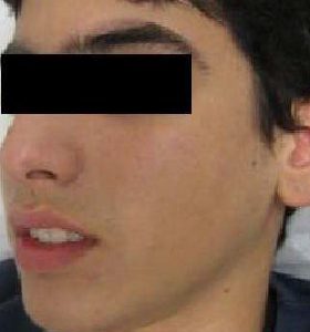 Acne Treatment For Teenage Boy After 8 Treatments. Sharplight