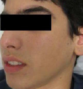 Acne Treatment For Teenage Boy After 8 Treatments. Sharplight