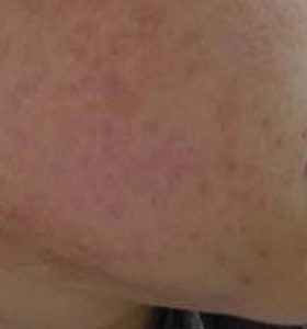 Acne Treatment - Lower cheek After 8 Treatments . Sharplight