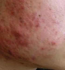 Acne Type1 Before Treatment . Sharplight