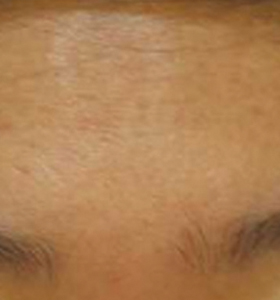 Acne Treatment - Forehead After 8 Month Treatment . Sharplight