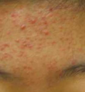 Acne Treatment - Forehead Before Treatment . Sharplight