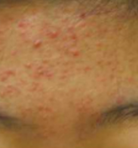 Acne Treatment - Forehead Before Treatment . Sharplight