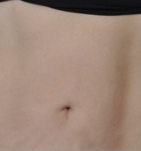 Body Contouring Treatment - Belly After 11 Treatment . Sharplight
