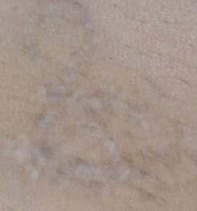 Tattoo Removal Treatment- lizard After 3 Treatments . Sharplight