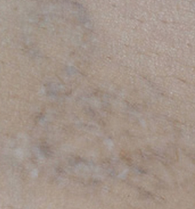 Tattoo Removal Treatment- lizard After 3 Treatments . Sharplight