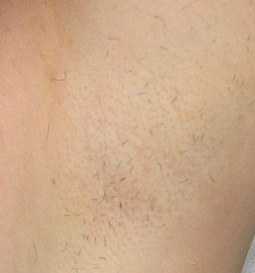 Hair Removal Treatment - Armpits After 2 Treatment - Sharplight