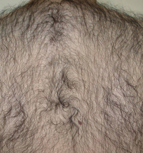 Hair Removal Treatment - A Man's Back .Befor 6 Treatments - Sharplight