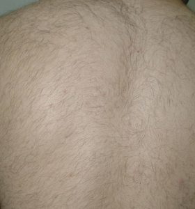 Hair Removal Treatment - A Man's Back .After 6 Treatments - Sharplight