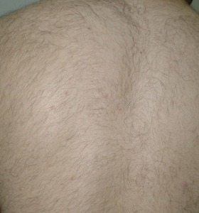 Hair Removal Treatment - A Man's Back .After 6 Treatments - Sharplight