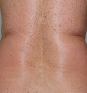 Body Contouring Treatment- Back Before Treatment . Sharplight