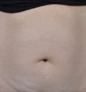 Body Contouring Treatment - Belly Before . Sharplight