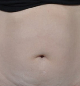 Body Contouring Treatment - Belly Before . Sharplight