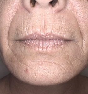 Skin Rejuvenation Treatment - Lower Face - Before Treatment . Sharplight