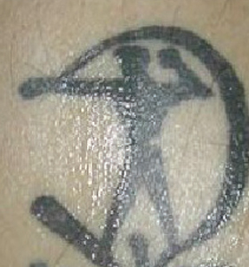 Tattoo Removal Treatment- Sagittarius Before Treatment . Sharplight