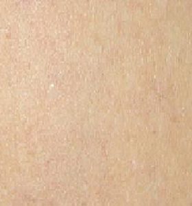 Vascular Lesions Treatment Broken Capillaries After 2 Monthly . Sharplight