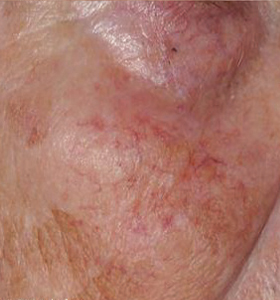 Vascular Lesions- Female Face Before Treatment . Sharplight