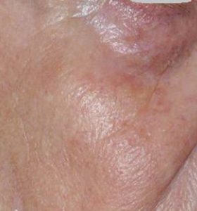 Vascular Lesions Female Face After 2 Treatment . Sharplight